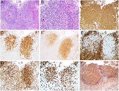 Case Report: Multiple Chromosomal Translocations Including Novel CIITA-CREBBP Fusion and Mutations in a Follicular Lymphoma